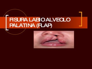 FISURA LABIO ALVEOLO PALATINA (FLAP) 