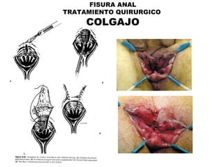 FISURA ANAL TRATAMIENTO QUIRURGICO  COLGAJO 