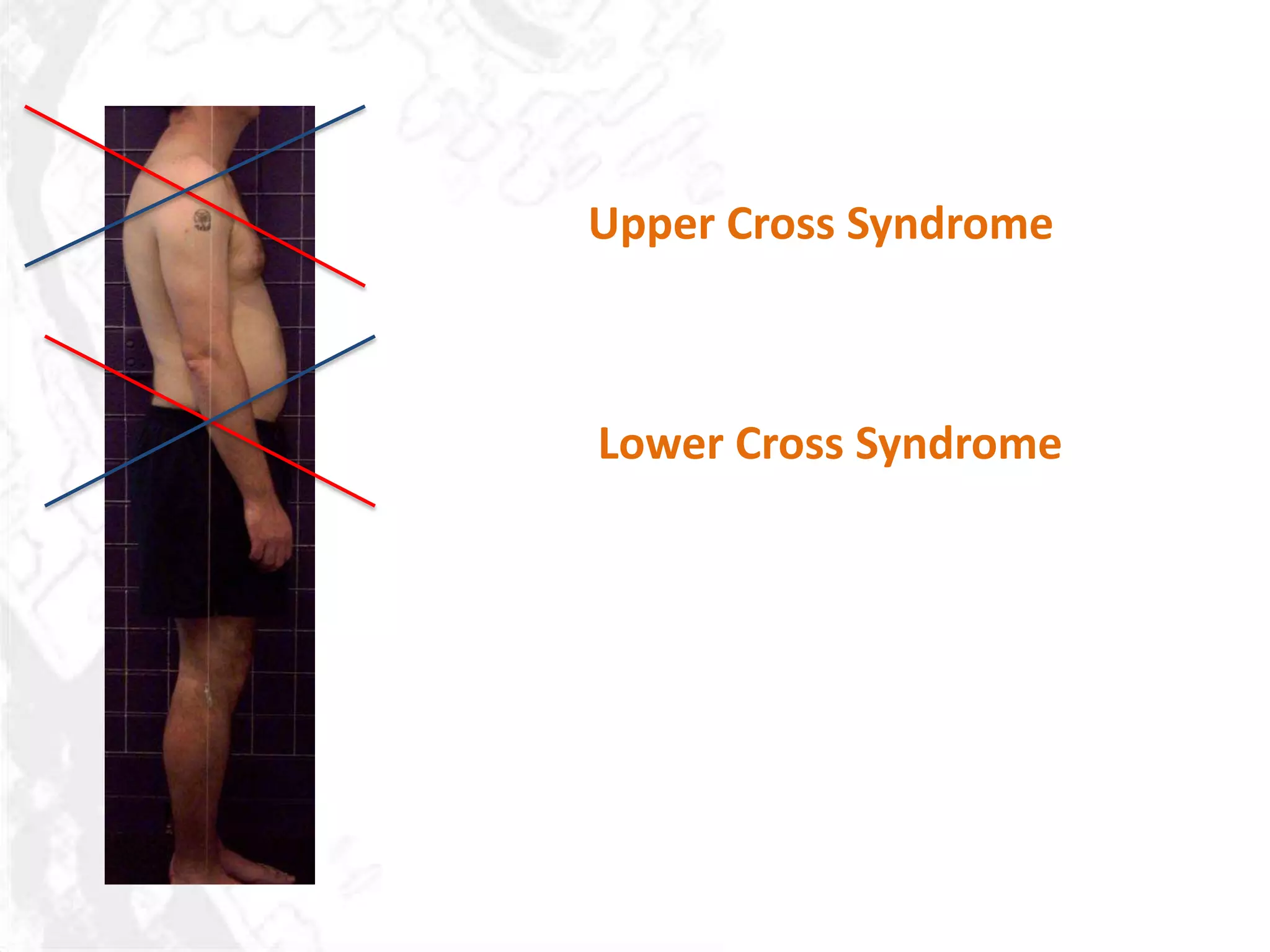 Upper Cross Syndrome



Lower Cross Syndrome
 