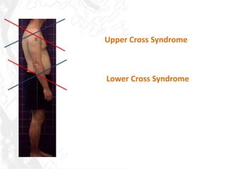 Upper Cross Syndrome



Lower Cross Syndrome
 