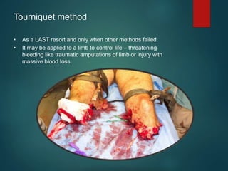 Tourniquet method
• As a LAST resort and only when other methods failed.
• It may be applied to a limb to control life – threatening
bleeding like traumatic amputations of limb or injury with
massive blood loss.
 