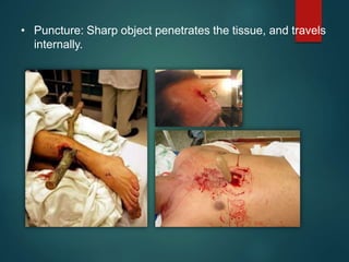 • Puncture: Sharp object penetrates the tissue, and travels
internally.
 