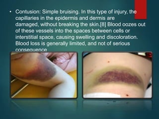 • Contusion: Simple bruising. In this type of injury, the
capillaries in the epidermis and dermis are
damaged, without breaking the skin.[8] Blood oozes out
of these vessels into the spaces between cells or
interstitial space, causing swelling and discoloration.
Blood loss is generally limited, and not of serious
consequence
 