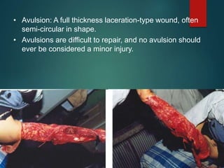 • Avulsion: A full thickness laceration-type wound, often
semi-circular in shape.
• Avulsions are difficult to repair, and no avulsion should
ever be considered a minor injury.
 