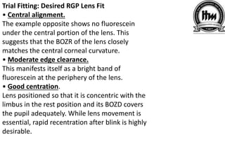 Trial Fitting: Desired RGP Lens Fit
• Central alignment.
The example opposite shows no fluorescein
under the central portion of the lens. This
suggests that the BOZR of the lens closely
matches the central corneal curvature.
• Moderate edge clearance.
This manifests itself as a bright band of
fluorescein at the periphery of the lens.
• Good centration.
Lens positioned so that it is concentric with the
limbus in the rest position and its BOZD covers
the pupil adequately. While lens movement is
essential, rapid recentration after blink is highly
desirable.
 