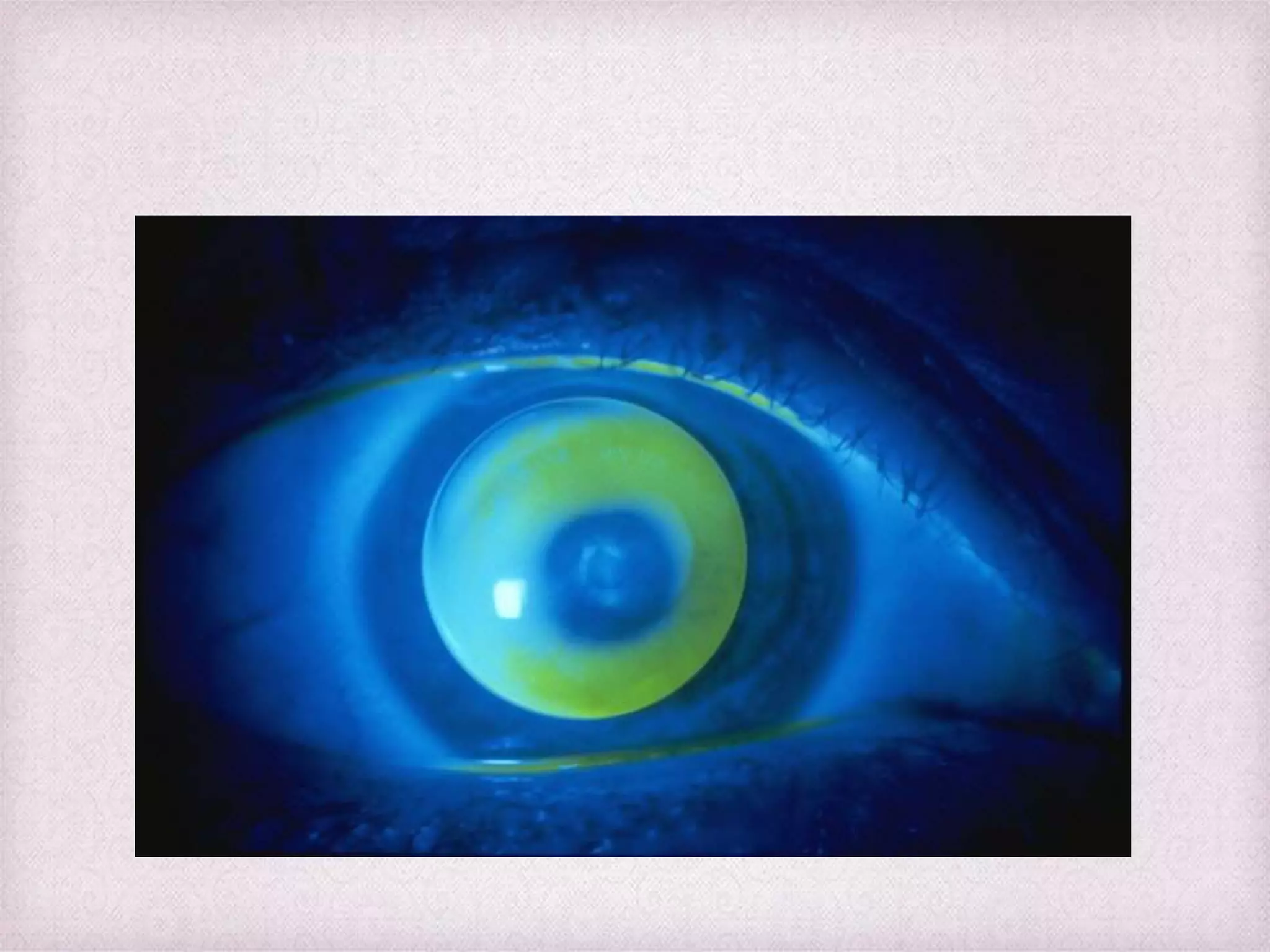 Fitting Philosophies and Assessment of Spherical RGP lenses | PPTX