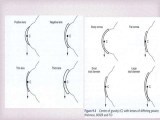 Fitting Philosophies and Assessment of Spherical RGP lenses | PPTX