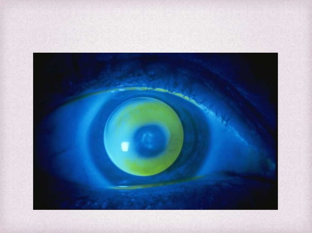 Fitting Philosophies and Assessment of Spherical RGP lenses | PPTX ...