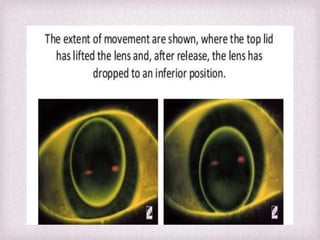 Fitting Philosophies and Assessment of Spherical RGP lenses | PPTX