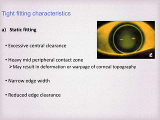 Edge Clearance Rgp Fitting Philosophies and Assessment of Spherical RGP lenses | PPTX