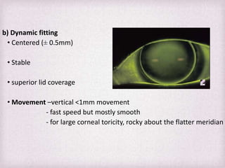 Toroidal Rgp Fitting Pattern Fitting Philosophies and Assessment of Spherical RGP lenses | PPTX