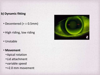 Best Rgp Pattern Fit Fitting Philosophies and Assessment of Spherical RGP lenses | PPTX