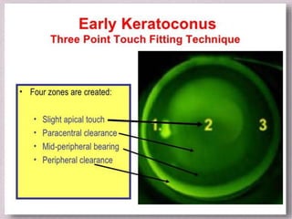 Fitting Philosophies and Assessment of Spherical RGP lenses | PPTX