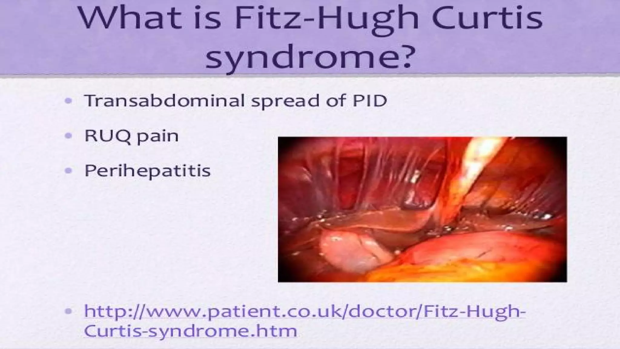 Fitz Hugh Curtis Syndrome PPT