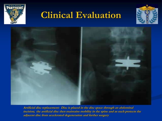 _FIU - Thoracic and Lumbar Spine Special Tests and Pathologies (1 ...