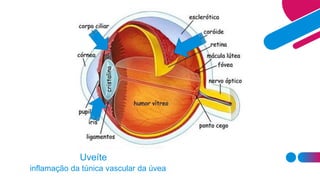 Uveíte
inflamação da túnica vascular da úvea
 