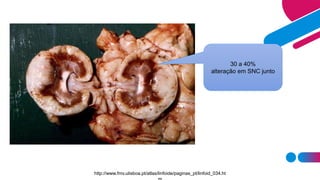 30 a 40%
alteração em SNC junto
http://www.fmv.ulisboa.pt/atlas/linfoide/paginas_pt/linfoid_034.ht
 