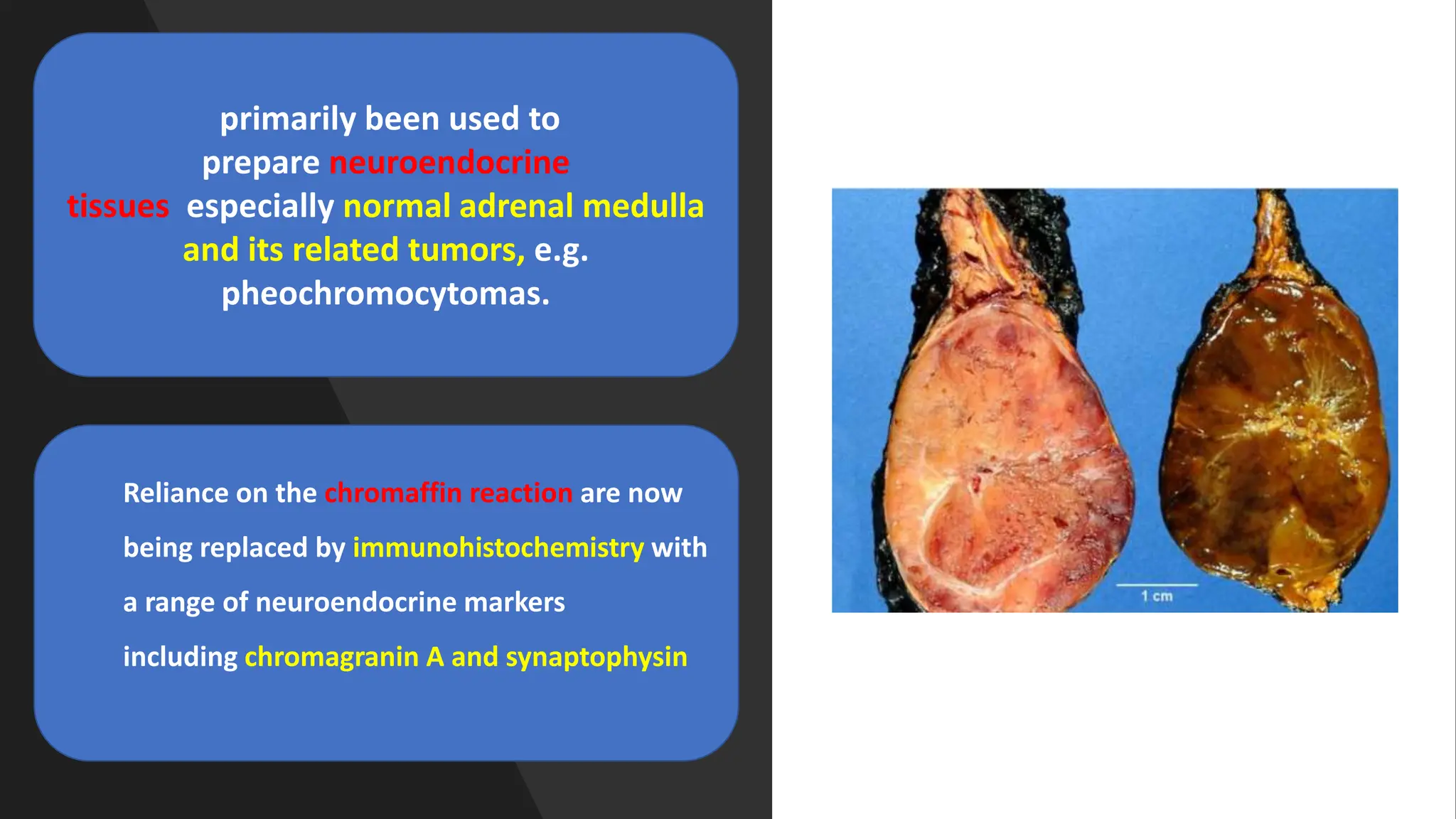 primarily been used to
prepare neuroendocrine
tissues especially normal adrenal medulla
and its related tumors, e.g.
pheochromocytomas.
Reliance on the chromaffin reaction are now
being replaced by immunohistochemistry with
a range of neuroendocrine markers
including chromagranin A and synaptophysin
 
