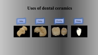 Uses of dental ceramics
Inlay Pinlay
Overlay
Onlay
 