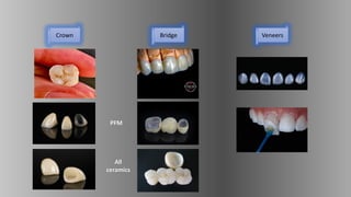 Crown Bridge Veneers
PFM
All
ceramics
 