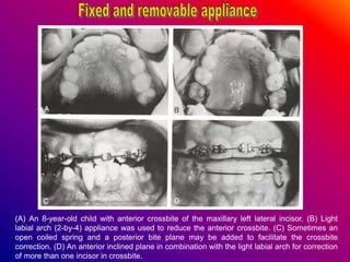(A) An 8-year-old child with anterior crossbite of the maxillary left lateral incisor. (B) Light
labial arch (2-by-4) appliance was used to reduce the anterior crossbite. (C) Sometimes an
open coiled spring and a posterior bite plane may be added to facilitate the crossbite
correction. (D) An anterior inclined plane in combination with the light labial arch for correction
of more than one incisor in crossbite.
 