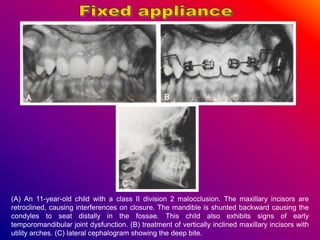 (A) An 11-year-old child with a class II division 2 malocclusion. The maxillary incisors are
retroclined, causing interferences on closure. The mandible is shunted backward causing the
condyles to seat distally in the fossae. This child also exhibits signs of early
temporomandibular joint dysfunction. (B) treatment of vertically inclined maxillary incisors with
utility arches. (C) lateral cephalogram showing the deep bite.
 