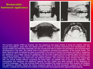 The function regular (FR2) by Frankel. (A) The appliance has large shields to keep the cheeks, with the
buccal musculature, away from the dental arches in order to promote transverse arch development. The
buccal shields are extended maximally into the mucobuccal fold to stretch the periosteum and promote bone
development in this area. (B) Lateral view of the appliance showing the extension of the buccal shield. The
lower labial lip pads are placed as deep as possible in the sulcus to stretch the tissues and help in stabilizing
the appliance. (C) Lingual view of the appliance with the lower lingual pad that is placed below the teeth and
the marginal gingiva. The intention with the lingual pad is to exert pressure on the sensitive mucosa if the
patient brings the lower jaw back from the postural position. The cross-over wires connect the lingual pad
with the buccal shields without contacting the lower teeth. (D) palatal view of the function regulator. The
transpalatal wire stabilizes the appliance against the first molars and adds strength to the appliance to
minimize breakages. There are occlusal stops at the maxillary first molars to control their eruption ad stabilize
the appliance vertically. Notice the heavy crossover wires at the first bicuspids. Lingual to the maxillary
incisors, a palatal wire prevents the eruption of these teeth and supports them against lingual tipping.
 