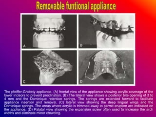 The pfeiffer-Grobety appliance. (A) frontal view of the appliance showing acrylic coverage of the
lower incisors to prevent proclination. (B) The lateral view shows a posterior bite opening of 3 to
4 mm and the Dominique retention springs. The springs are extended forward to facilitate
appliance insertion and removal. (C) lateral view showing the deep lingual wings and the
Dominique springs. The areas where acrylic is trimmed away to permit eruption are indicated on
the appliance. (D) Palatal view showing the expansion screw often used to increase the arch
widths and eliminate minor crowding.
 