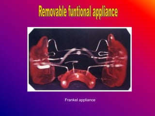 Frankel appliance
 