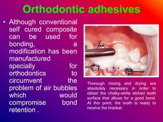 Orthodontic adhesives
• Although conventional
self cured composite
can be used for
bonding, a
modification has been
manufactured
specially for
orthodontics to
circumvent the
problem of air bubbles
which would
compromise bond
retention .
Thorough rinsing and drying are
absolutely necessary in order to
obtain the chalky-white etched tooth
surface that allows for a good bond.
At this point, the tooth is ready to
receive the bracket.
 