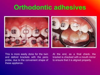 Orthodontic adhesives
This is more easily done for the twin
and deltoid brackets with the perio
probe, due to the convenient shape of
these appliance.
At the end, as a final check, the
bracket is checked with a mouth mirror
to ensure that it is aligned properly.
 