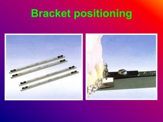 Bracket positioning
 