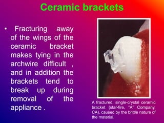 Ceramic brackets
• Fracturing away
of the wings of the
ceramic bracket
makes tying in the
archwire difficult ,
and in addition the
brackets tend to
break up during
removal of the
appliance .
A fractured, single-crystal ceramic
bracket (star-fire, “A” Company,
CA), caused by the brittle nature of
the material.
 