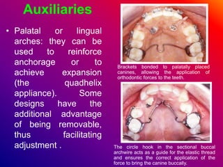 Auxiliaries
• Palatal or lingual
arches: they can be
used to reinforce
anchorage or to
achieve expansion
(the quadhelix
appliance). Some
designs have the
additional advantage
of being removable,
thus facilitating
adjustment .
Brackets bonded to palatally placed
canines, allowing the application of
orthodontic forces to the teeth.
The circle hook in the sectional buccal
archwire acts as a guide for the elastic thread
and ensures the correct application of the
force to bring the canine buccally.
 