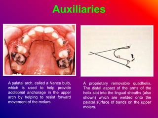 Auxiliaries
A palatal arch, called a Nance bulb,
which is used to help provide
additional anchorage in the upper
arch by helping to resist forward
movement of the molars.
A proprietary removable quadhelix.
The distal aspect of the arms of the
helix slot into the lingual sheaths (also
shown) which are welded onto the
palatal surface of bands on the upper
molars.
 