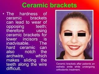 Ceramic brackets
• The hardness of
ceramic brackets
can lead to wear of
opposing teeth;
therefore using
ceramic brackets for
lower incisors is
inadvisable. The
hard ceramic can
also notch the
archwire, which
makes sliding the
teeth along the wire
difficult.
Ceramic brackets after patients an
esthetic smile while undergoing
orthodontic treatment.
 