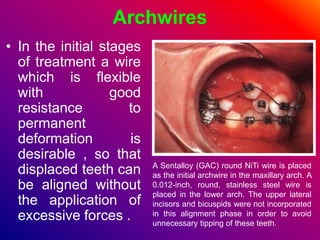 Archwires
• In the initial stages
of treatment a wire
which is flexible
with good
resistance to
permanent
deformation is
desirable , so that
displaced teeth can
be aligned without
the application of
excessive forces .
A Sentalloy (GAC) round NiTi wire is placed
as the initial archwire in the maxillary arch. A
0.012-inch, round, stainless steel wire is
placed in the lower arch. The upper lateral
incisors and bicuspids were not incorporated
in this alignment phase in order to avoid
unnecessary tipping of these teeth.
 