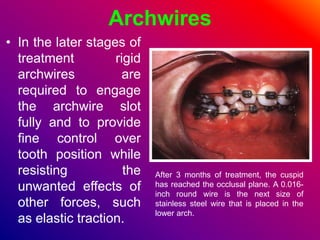 Archwires
• In the later stages of
treatment rigid
archwires are
required to engage
the archwire slot
fully and to provide
fine control over
tooth position while
resisting the
unwanted effects of
other forces, such
as elastic traction.
After 3 months of treatment, the cuspid
has reached the occlusal plane. A 0.016-
inch round wire is the next size of
stainless steel wire that is placed in the
lower arch.
 
