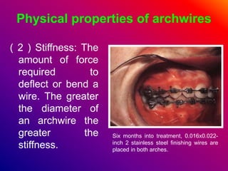 Physical properties of archwires
( 2 ) Stiffness: The
amount of force
required to
deflect or bend a
wire. The greater
the diameter of
an archwire the
greater the
stiffness.
Six months into treatment, 0.016x0.022-
inch 2 stainless steel finishing wires are
placed in both arches.
 