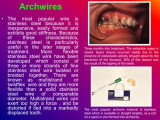 Archwires
• The most popular wire is
stainless steel because it is
inexpensive, easily formed and
exhibits good stiffness. Because
of these characteristics,
stainless steel is particularly
useful in the later stages of
treatment. More flexible
stainless steel wire have been
developed which consist of
three or more strands of fine
stainless steel wire twisted or
braided together. There are
known as multistrand or
twistflex wire and they are more
flexible than a solid stainless
steel wire of comparable
diameter. Multistrand wires can
exert too high a force , and be
distorted if tied into a markedly
displaced tooth.
The most popular archwire material is stainless
steel which is available in straight lengths, as a coil
on a spool or pre-formed into archwires.
Three months into treatment. The extraction space is
closed. Space closure occurred rapidly due to the
presence of osteoclastic activity brought about by the
extraction of the bicuspid; 30% of this closure was
the result of the tipping of the teeth.
 