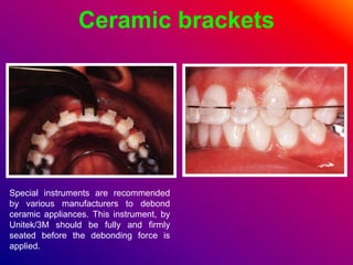 Ceramic brackets
Special instruments are recommended
by various manufacturers to debond
ceramic appliances. This instrument, by
Unitek/3M should be fully and firmly
seated before the debonding force is
applied.
 