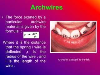 Archwires
• The force exerted by a
particular archwire
material is given by the
formula :
Where d is the distance
that the spring / wire is
deflected ,r is the
radius of the wire , and
l is the length of the
wire .
Archwire “skewed” to the left.
 