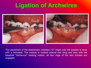 Ligation of Archwires
The placement of the elastomeric modules (“O” rings) over the bracket is done
with a hemostat. The module is hooked around one wing and then with the
baseball “horme-run” twisting motion, all four rings of the twin bracket are
engaged.
 