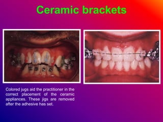 Ceramic brackets
Colored jugs aid the practitioner in the
correct placement of the ceramic
appliances. These jigs are removed
after the adhesive has set.
 
