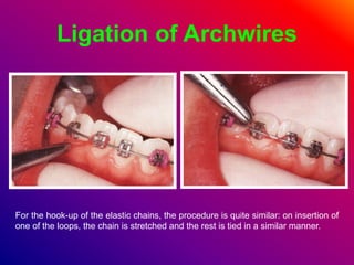 Ligation of Archwires
For the hook-up of the elastic chains, the procedure is quite similar: on insertion of
one of the loops, the chain is stretched and the rest is tied in a similar manner.
 