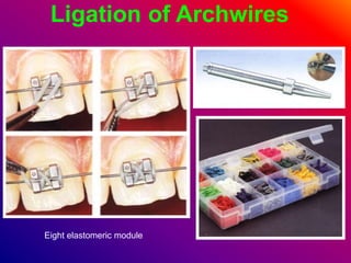 Ligation of Archwires
Eight elastomeric module
 