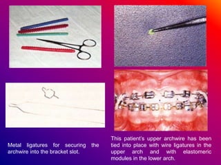 Metal ligatures for securing the
archwire into the bracket slot.
This patient’s upper archwire has been
tied into place with wire ligatures in the
upper arch and with elastomeric
modules in the lower arch.
 