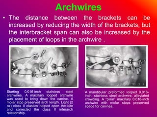 Archwires
• The distance between the brackets can be
increased by reducing the width of the brackets, but
the interbracket span can also be increased by the
placement of loops in the archwire .
Starting 0.016-inch stainless steel
archwires. A maxillary looped archwire
was used to bring down the canine. A
molar stop preserved arch length. Light (2
oz) class II elastics helped open the bite
and corrected the class II interarch
relationship.
A mandibular preformed looped 0.016-
inch, stainless steel archwire, alleviated
crowding. A “plain” maxillary 0.016-inch
archwire with molar stops preserved
space for canines.
 