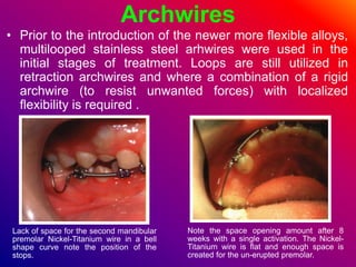 Archwires
• Prior to the introduction of the newer more flexible alloys,
multilooped stainless steel arhwires were used in the
initial stages of treatment. Loops are still utilized in
retraction archwires and where a combination of a rigid
archwire (to resist unwanted forces) with localized
flexibility is required .
Lack of space for the second mandibular
premolar Nickel-Titanium wire in a bell
shape curve note the position of the
stops.
Note the space opening amount after 8
weeks with a single activation. The Nickel-
Titanium wire is flat and enough space is
created for the un-erupted premolar.
 