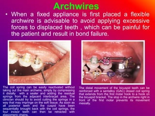 Archwires
• When a fixed appliance is first placed a flexible
archwire is advisable to avoid applying excessive
forces to displaced teeth , which can be painful for
the patient and result in bond failure.
The coil spring can be easily reactivated without
taking out the main archwire, simply by compressing
it distally with a sealer and adding the residual
springs from the adjacent interbracjet area. The
clinician should try to avoid cutting the springs in a
way that may impringe on the soft tissue. As soon as
all posterior teeth and the cuspid have been
sequentially brought back with the coil springs, the
four incisor teeth can then be retracted with
elasiomeric chains.
The distal movement of the bicuspid teeth can be
reinforced with a sentalloy (GAC) closed coil spring
that extends from the first molar hook to a hook on
the bicuspid bracket. The stop in the archwire right in
front of the first molar prevents its movement
mesially.
 